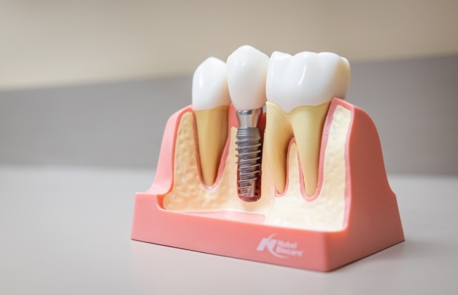 Model dental implant supported dental crown