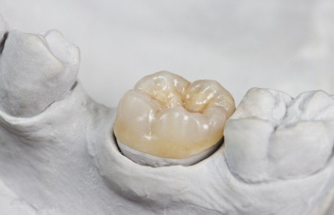 Model smile with dental crown