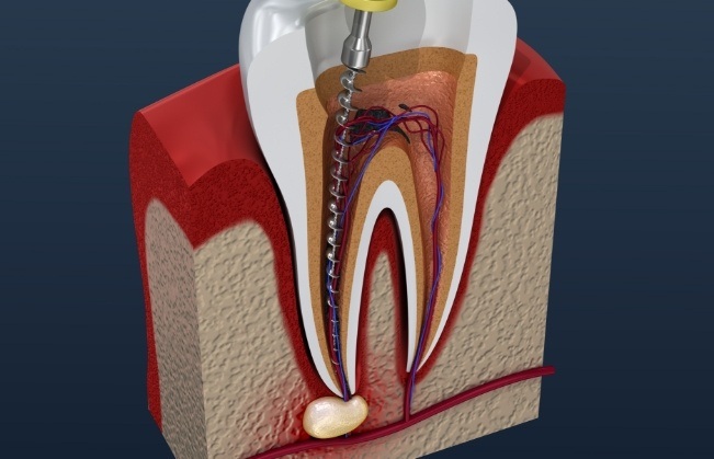 Animated tooth during root canal treatment