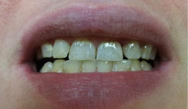 Closeup of beautiful smile after dental restoration