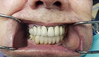 Smile with replaced bottom teeth