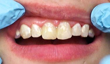 Closeup of smile with repaired top front teeth