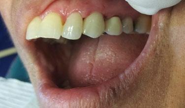 Top tooth repaired