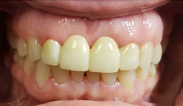 Smile after gap between top front teeth is closed