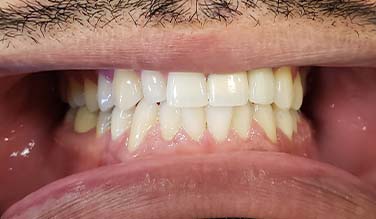 Top side tooth replaced