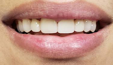 Flawless smile after cosmetic dentistry