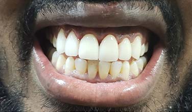 Healthy bright white smile after cosmetic dentistry