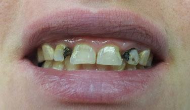 Closeup of decayed smile before dental restoration