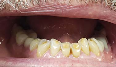 Smile with extensive dental decay and discoloration