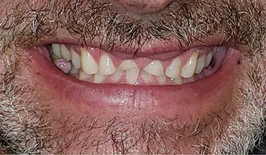 Worn down top front teeth