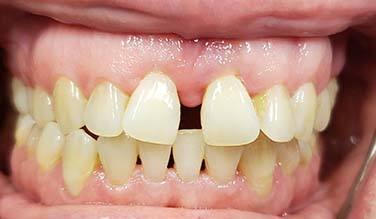 Smile with large gap between top front teeth