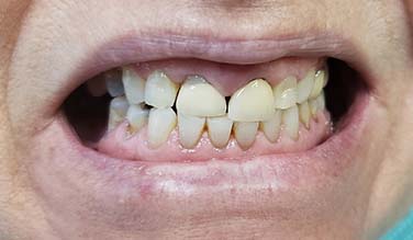 Damaged and broken teeth before cosmetic dentistry