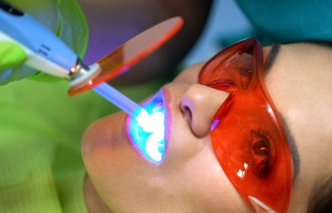 Closeup of dental patient during teeth whitening treatment