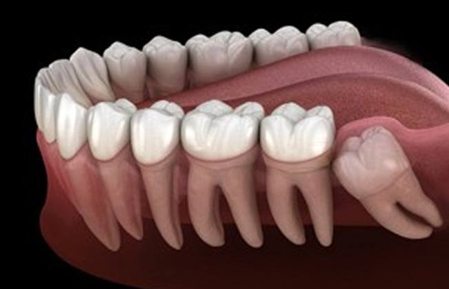 Animated smile with impacted wisdom tooth