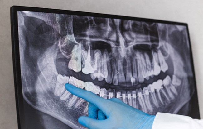 Dentist pointing to wisdom tooth on an X-ray