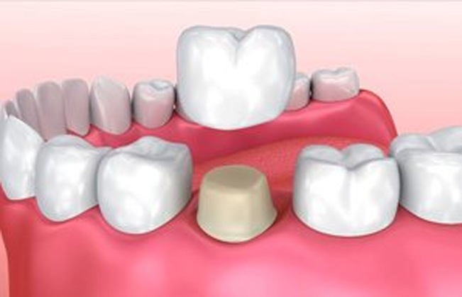 Animated smile during full zirconia dental crown placement
