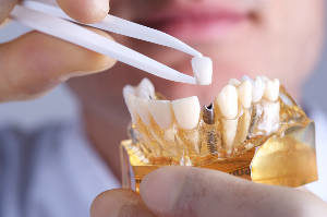 Kent Dental Implants