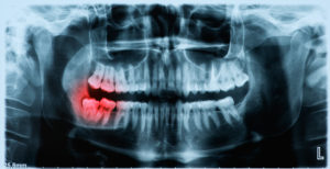 x-ray image of wisdom tooth