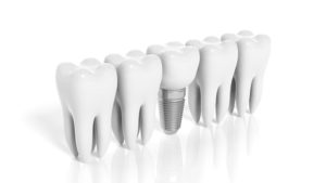 dental implant and molars