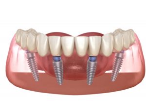 Illustration of prosthetic teeth supported by All-on-4 dental implants
