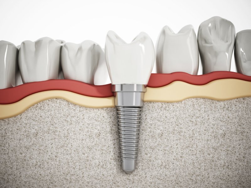 Dental implant in Kent embedded in jaw