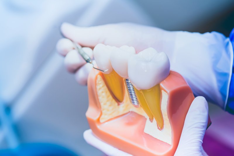Dentist pointing to parts of dental implant model